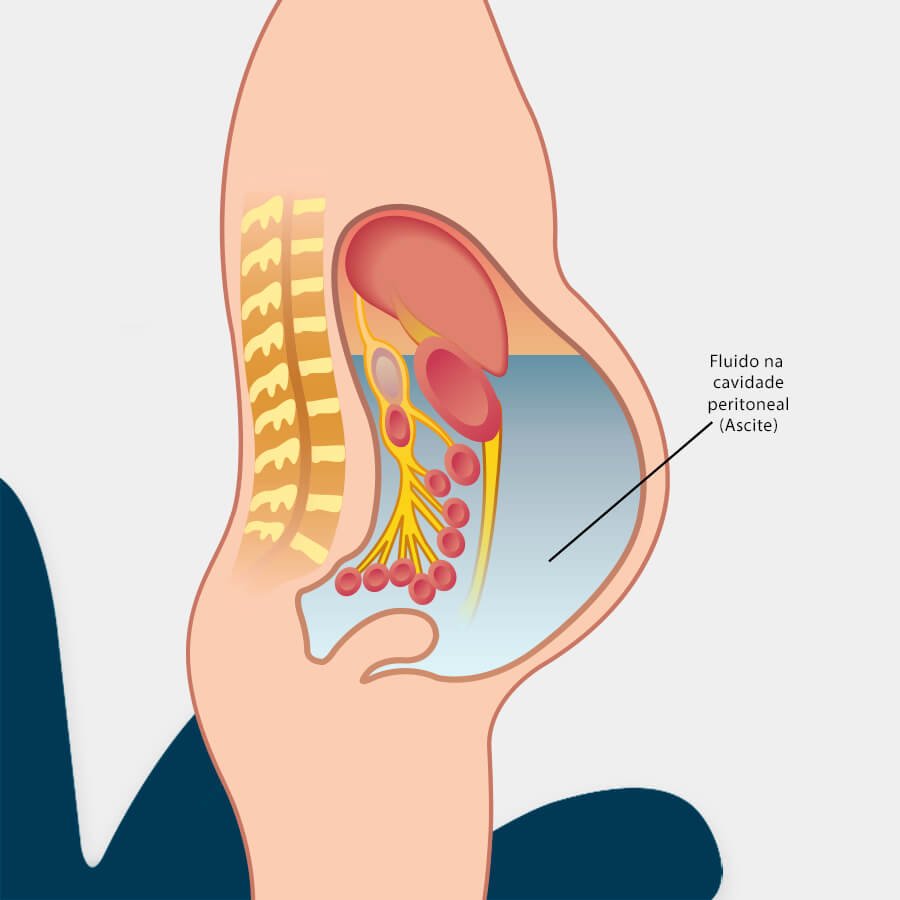 Imagem Carcinomatose Peritoneal
