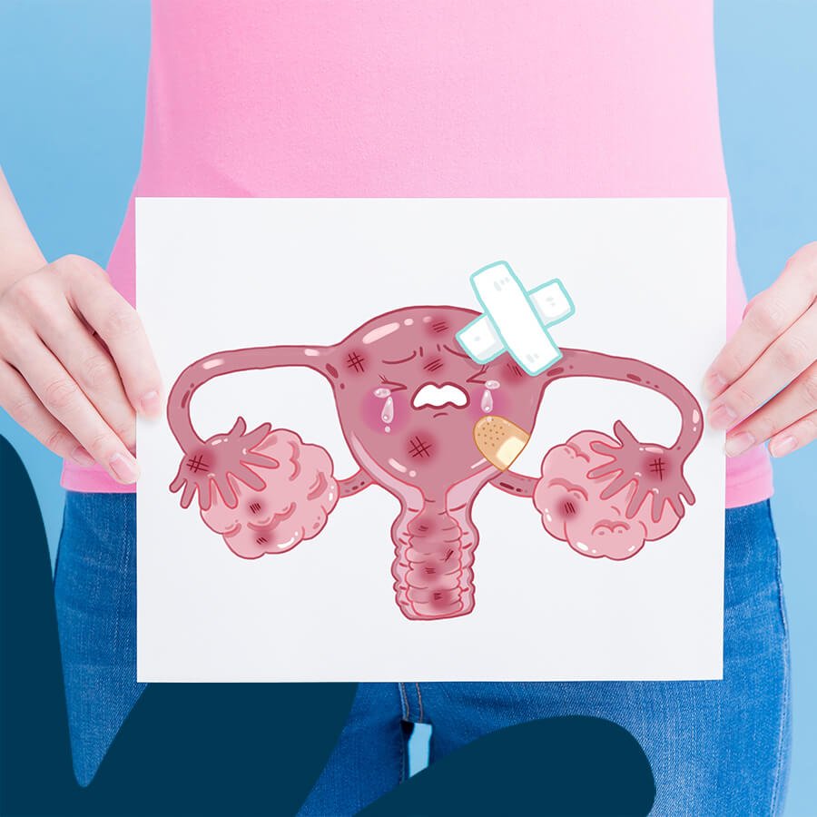 Imagem Neoplasia de Ovário